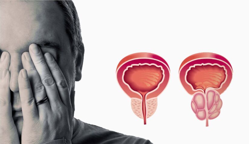 Prostatitis kronikoa