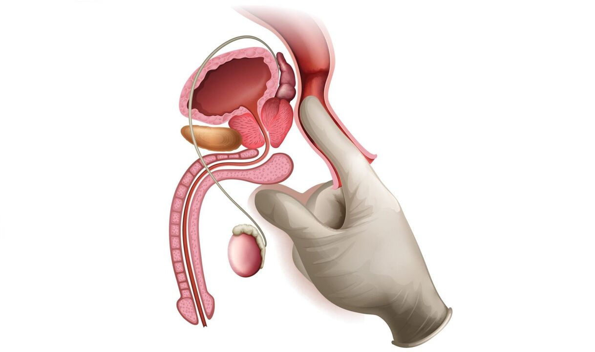 prostatako masajea prostatitisa egiteko