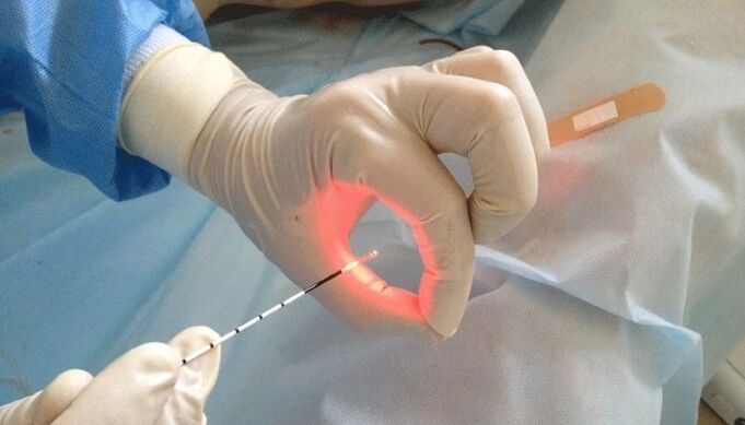 prostatitisaren laser tratamendua